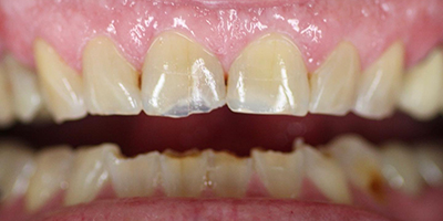 Before dental treatment with our Green Bay Dentists