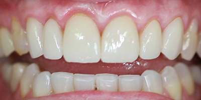 After dental treatment with our Green Bay Dentists