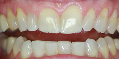 Before dental treatment with our Green Bay Dentists