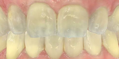 After dental treatment with our Green Bay Dentists