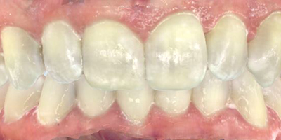 After dental treatment with our Green Bay Dentists