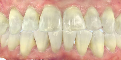 After dental treatment with our Green Bay Dentists