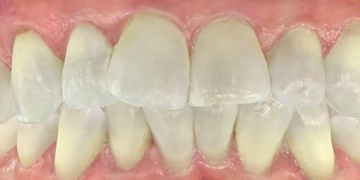 BEfore dental treatment with our Green Bay Dentists