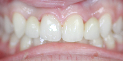 After dental treatment with our Green Bay Dentists