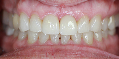After dental treatment with our Green Bay Dentists