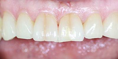 Before dental treatment with our Green Bay Dentists