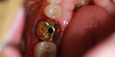 Before dental treatment with our Green Bay Dentists