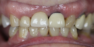 After dental treatment with our Green Bay Dentists