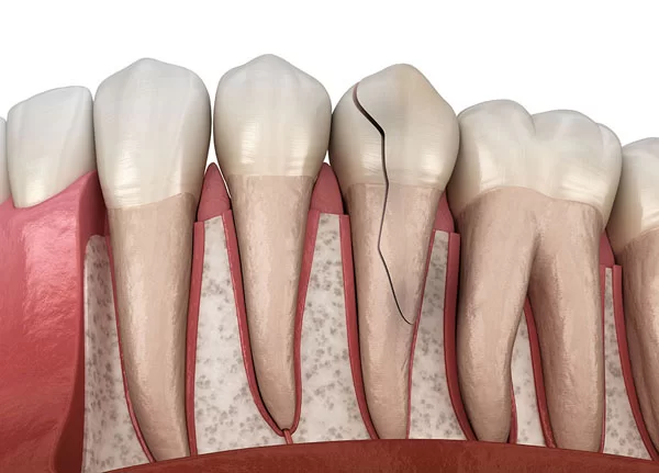 types of tooth cracks