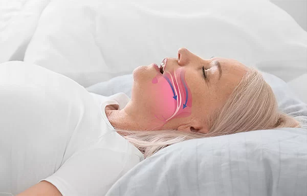 model of obstructive sleep apnea
