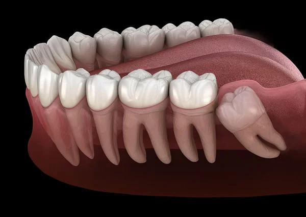 wisdom teeth removal in Green Bay